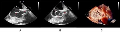 Percutaneous snare-retrieval of intracardiac thrombus under fluoroscopic and transesophageal echocardiography guidance: case report and systematic review